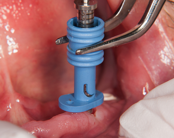 Zeramex loc Locator, Zeramex P Implantat, Altus Hu00f6henmessleere