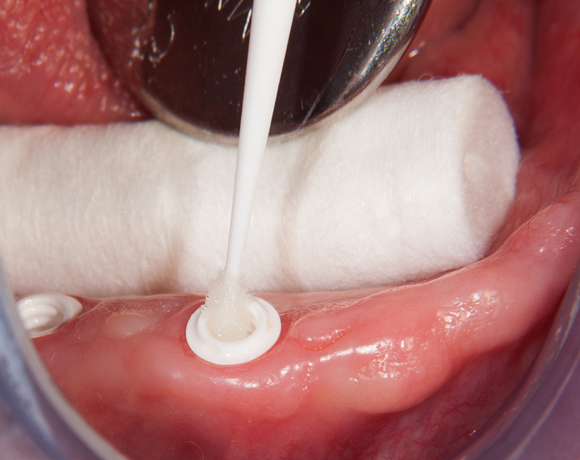 Zeramex loc Locator, Zeramex P Implantat