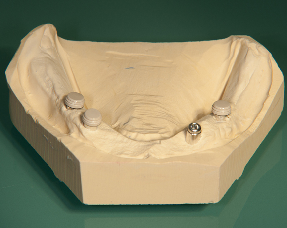 Zeramex loc Locator, Zeramex P Implantat, Novaloc, Valoc, PEEK Geru00fcst