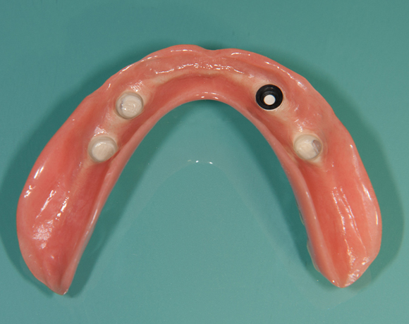 Zeramex loc Locator, Zeramex P Implantat, Novaloc, Valoc, PEEK Geru00fcst