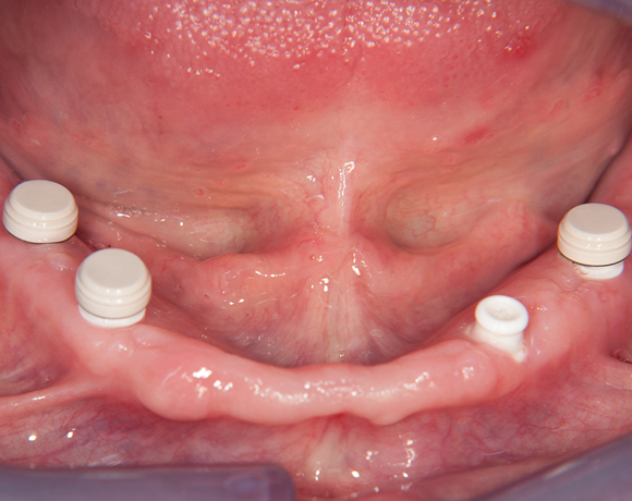 Zeramex loc Locator, Zeramex P Implantat, Novaloc, Valoc, PEEK Geru00fcst