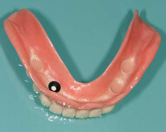 Zeramex loc Locator, Zeramex P Implantat, Novaloc, Valoc, PEEK Geru00fcst