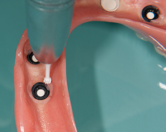 Zeramex loc Locator, Zeramex P Implantat, Novaloc, Valoc, PEEK Geru00fcst