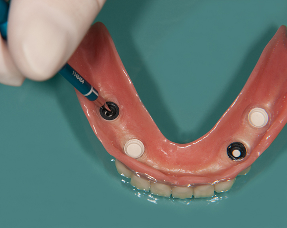 Zeramex loc Locator, Zeramex P Implantat, Novaloc, Valoc, PEEK Geru00fcst