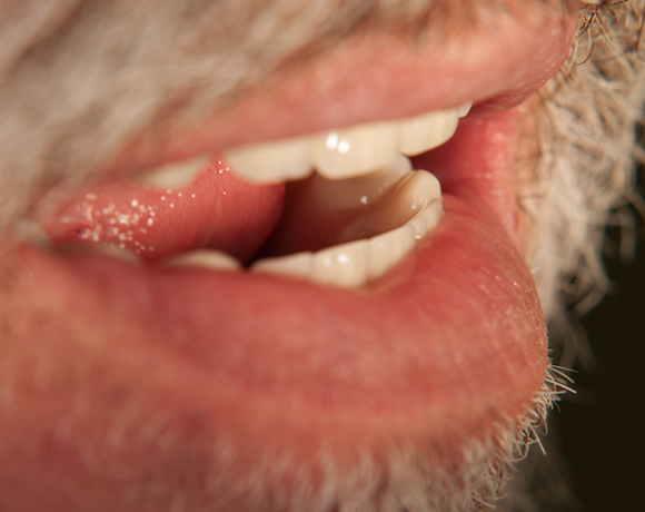 Zeramex loc Locator, Zeramex P Implantat, Novaloc, Valoc, PEEK Geru00fcst