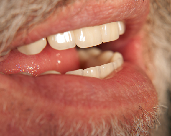 Zeramex loc Locator, Zeramex P Implantat, Novaloc, Valoc, PEEK Geru00fcst